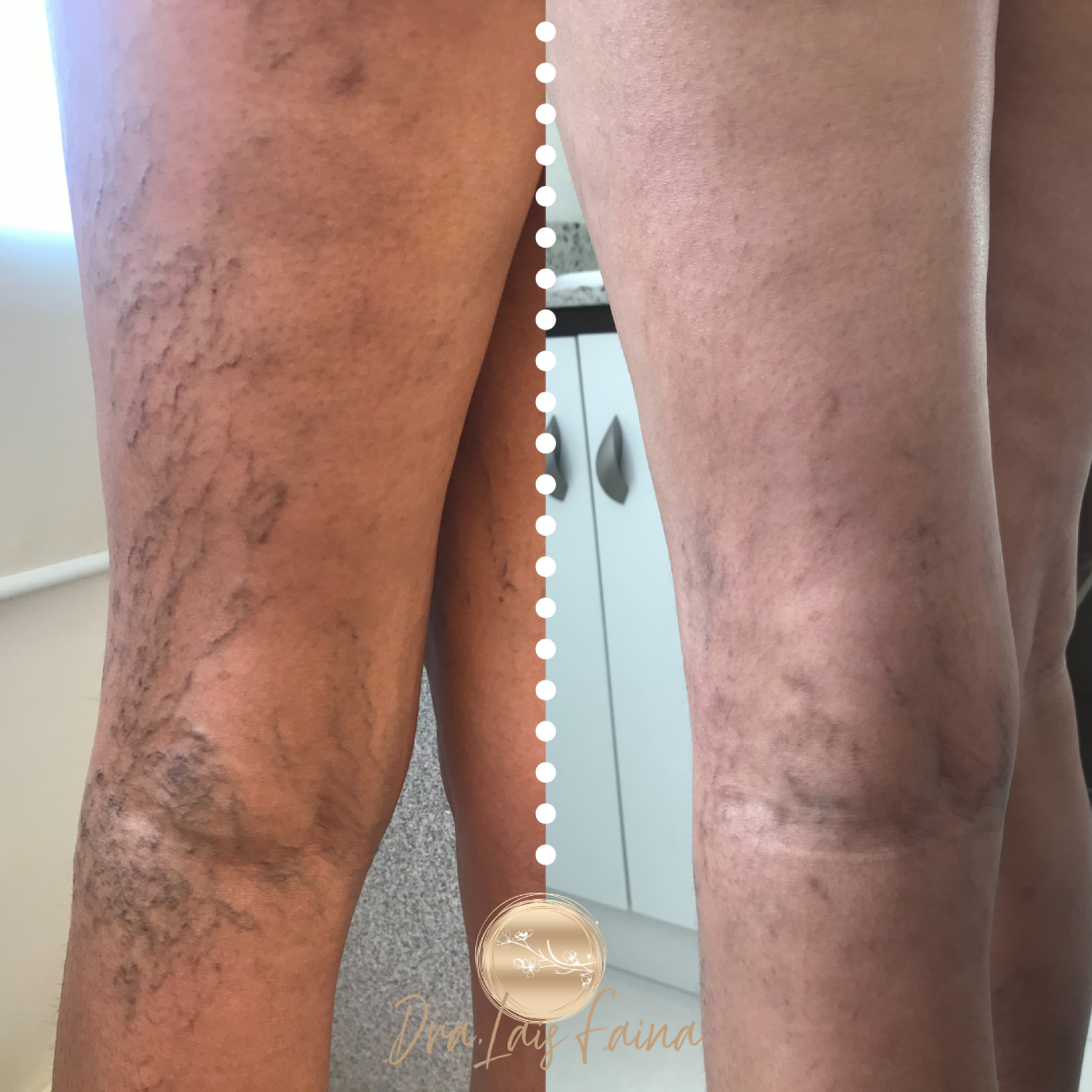 Dra Laís Faina - Espuma Densa