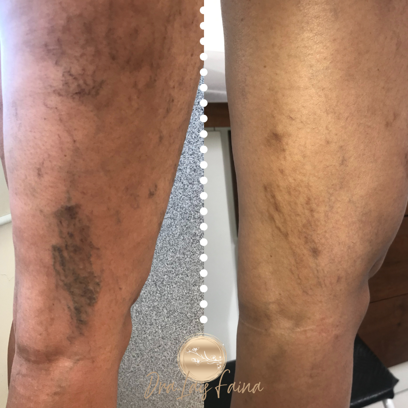 Dra Laís Faina - Espuma Densa