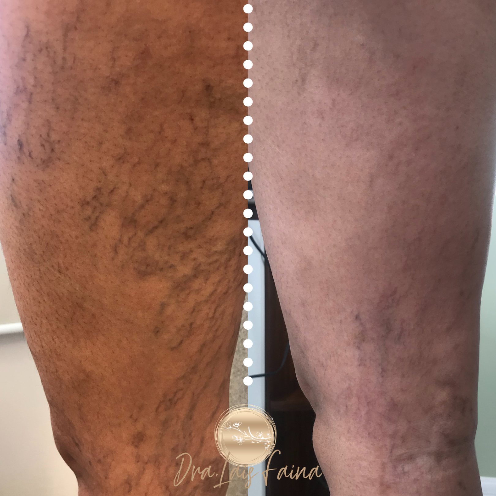 Dra Laís Faina - Espuma Densa